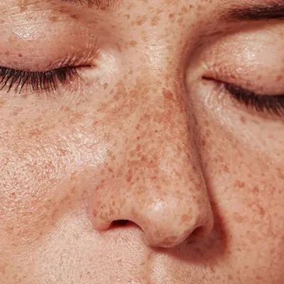 Dermal Pigmentation Treatment