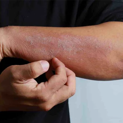 Eczema Treatment