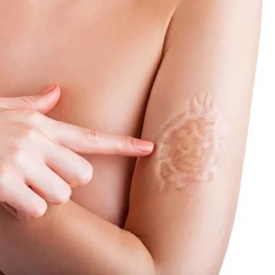 Scar Removal in Dubai