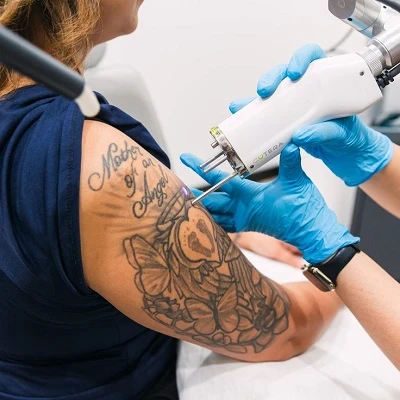 Tattoo Removal in Al Barsha