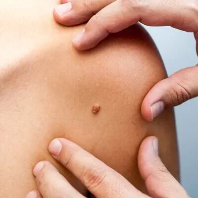 Wart Removal in Dubai