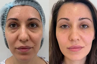 8 Point Facelift with Juvederm in Dubai before and after