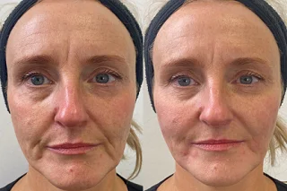 Anti Aging Treatment 4 Anti Aging Treatment in Dubai before and after