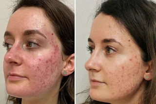 AquaGold Facial 4 AquaGold Facial in Dubai before and after