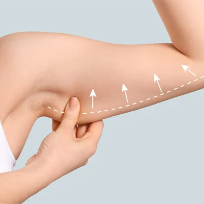 Arm Lift Surgery