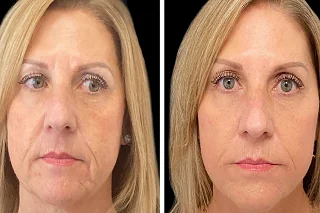 Before & After Cosmelan Peel