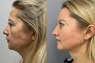 Belkyra Treatment 4 Before and After Belkyra Treatment
