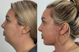 Nefertiti Lift Treatment 4 Before and After Nefertiti Lift Treatment