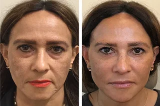 Under Eye Fillers 4 Before and After Under Eye Fillers