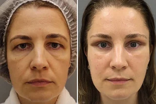 Belotero Filler Treatment 4 Belotero Filler Treatment in Dubai before and after