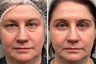 Best Botox in Silicon Oasis before and after