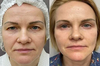 Volift Fillers 4 Best Volift Fillers in Dubai before and after