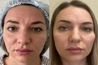 Botox Injection Dubai 4 Botox Injection Dubai before and after