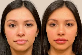 Botox Lip Flip 4 Botox Lip Flip in Dubai Before and After