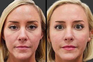 Cheek Fillers Injections 4 Cheek Filler Injections in Dubai before and after