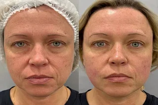 ClearLift laser in Dubai Before and After