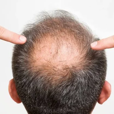 Crown Hair Transplant