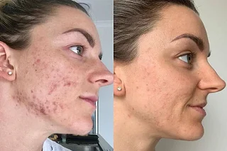 DMK Enzyme Therapy Facial 4 DMK Enzyme Therapy Facial in Dubai before and after