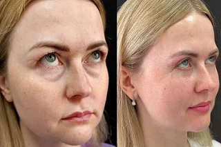 Dark Circles Treatment in Dubai before and after