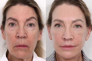 Derma Rollers Treatment 4 Derma Rollers Treatment in Dubai before and after