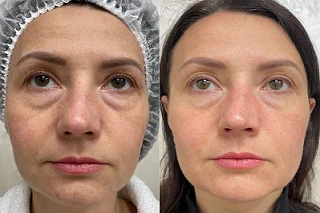 Dermal Fillers Injections 4 Dermal Fillers Injections in Dubai Before and After