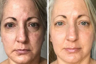 Dermapen Treatment in Dubai before and after