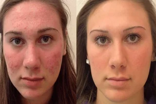 Diamond Peels in Dubai before and after