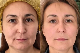 Dysport Injections in Dubai before and after