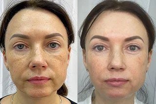 Endolift in Dubai Before and after