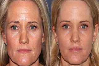 Erbium Peel in Dubai before and after