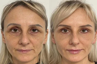 Facial Capillaries Treatment 4 Facial Capillaries Treatment in Dubai Before and After