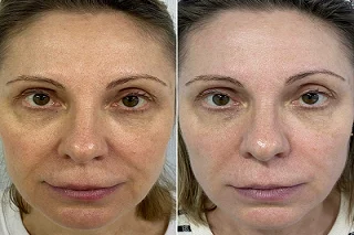 Filler Injections with PRP 4 Filler Injections with PRP in Dubai before and after