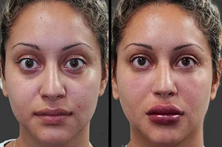 Fotona 4D Lip Augmentation in Dubai Before and After