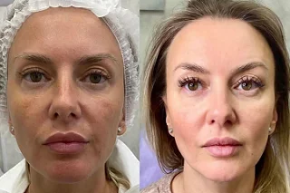 Fotona TwinLight Fractional Rejuvenation in Dubai Before and After