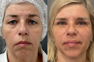 Fractional CO2 Laser Treatment Before and After