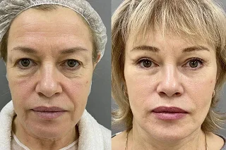 Fractional Laser with PRP Therapy 4 Fractional Laser with PRP Therapy in Dubai Before and After