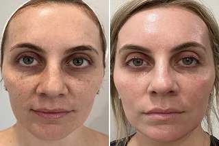 Fractional RF MicroNeedling 4 Fractional RF MicroNeedling in Dubai before and after