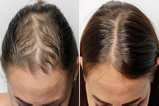 G Cell Treatment in Dubai before and after