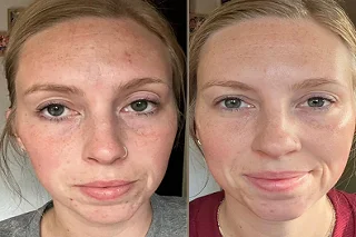 Glutathione Injections | Gluta IV Drip 4 Glutathione Injections in Dubai Before and After