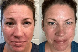 Green Peels Treatment 4 Green Peels Treatment in Dubai before and after