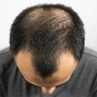 Hair Transplant Cost in Dubai