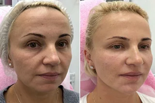 Halo Treatment in Dubai Before and After