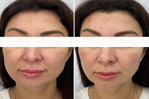 Hifu treatment dubai before & after