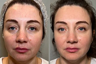 Hyaluronic Acid Injections in Dubai before and after