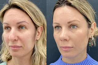 JALUPRO Skin Booster Injections in Dubai Before and After
