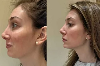 Jawline Fillers Injections in Dubai Before and After