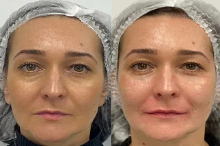 Juvederm Filler - Lip Filler 4 Juvederm Filler in Dubai Before and After