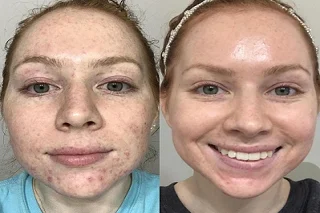 LED Light Therapy in Dubai Before and After