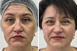 Laser Photo Rejuvenation 4 Laser Photo Rejuvenation in Dubai Before and After