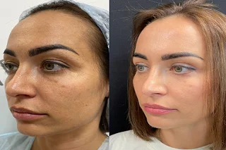 Laser Skin Resurfacing in Dubai Before and After